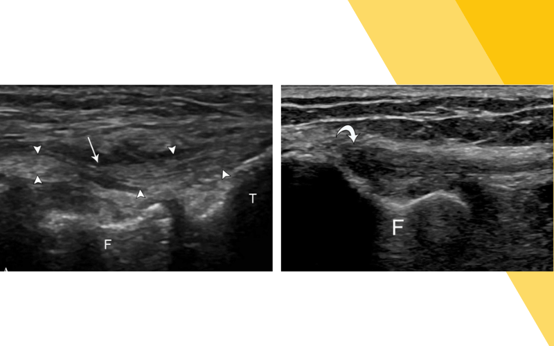 8. Evaluacion rodilla ecografia.png